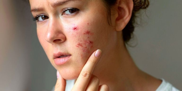 Dermatillomanie, un TOC que la sophrologie peut apaiser sophrologie dermatillomanie TOC